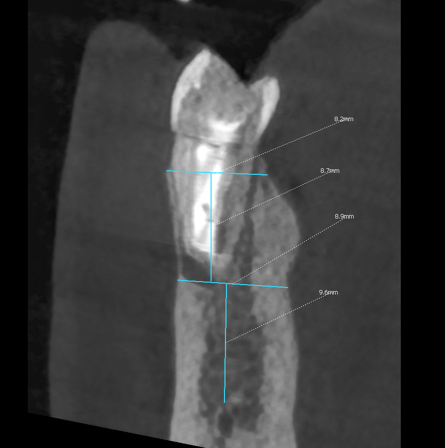 CBCT snimak zuba sekcioni presek sa merenjima