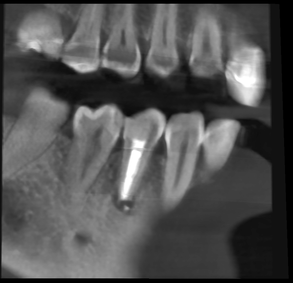 CBCT snimak zuba 45 sagitalni presek
